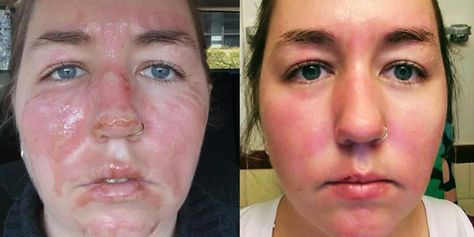 Woman Photos Show the Healing Process of Second-Degree Burns Second Degree Burn, Chemical Burn, Side By Side Photo, Woman Photos, Healing Abilities, Degree Burns, The Healing Process, Makeup School, Train Wreck