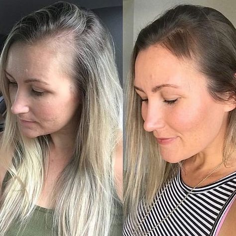 Monat Hair & Skin Testimonials on Instagram: “. . . . . . . . #hairtestimony #recedinghairline #monat #hairgoals #hairgrowth #hairgrowthsupplements #thinhairproblems #medicalhairloss…” Receding Hair Styles, Hair Growth Supplement, Monat Hair, Hair Skin, Hair Growth, Hair Goals, My Girl, Hair Care, Sparkle