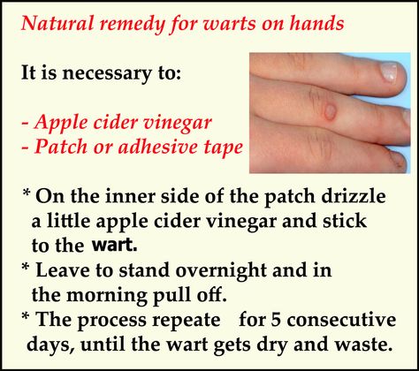 How to remove #wart from hands ? Age Spots Removal, Natural Wart Remedies, Wart On Finger, Warts On Hands, Warts On Face, Home Remedies For Allergies, How To Remove Warts, Home Remedies For Warts, Warts Remedy