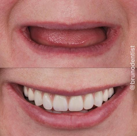 Complete Denture Before And After, Teeth Makeover, Tooth Bridge, Complete Denture, Dermatologist Skin Care, Affordable Dental Implants, Dental Images, Dental Implant Surgery, Dental Work