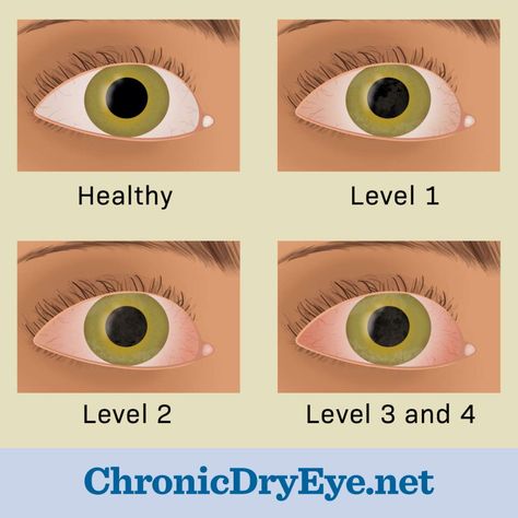 Eye Types, Chronic Dry Eye, Dry Eyes Causes, Dry Eye Symptoms, Salivary Gland, Dry Eye, Dry Mouth, Upper Eyelid, Types Of Eyes