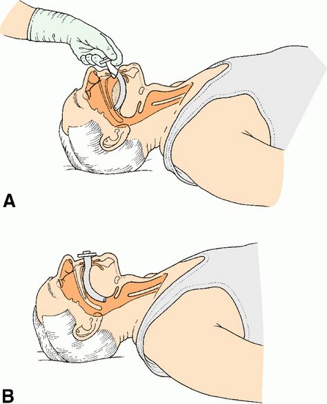 Oropharyngeal Airway, How To Perform Cpr, First Aid Tips, Cpr Training, Eye Anatomy, Critical Care Nursing, Medicine Student, Cpr, Critical Care