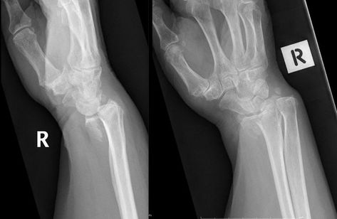 Reversed Barton Fracture - an intra-articular fracture at the distal radius with volar displacement of the fractured segments and dorsal subluxation of the radius and ulna with respect to the carpus. A further fracture is noted of the ulnar styloid. Radius And Ulna, Radiology, Chiropractic, Ballet Shoes, Dance Shoes, Sport Shoes, Health