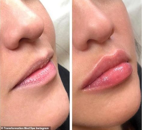 Lip 'threading' is the trend tipped to take over fillers: How nova threads work Lips Illustration, Lip Plumping Balm, Lips Inspiration, Permanente Make-up, Botox Lips, Korean Lips, Facial Fillers, Lip Scrub Diy, Peach Lips