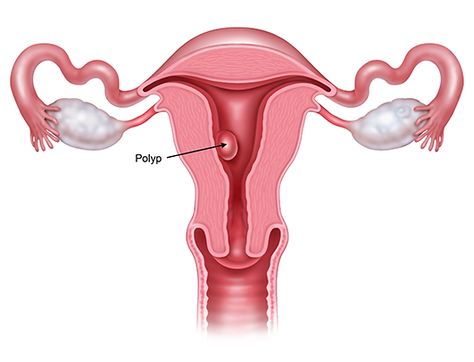 Polyps Uterus, Bicornuate Uterus, Uterine Polyps, Endometrial Polyps, Doctor Office Design, Low Oxalate Diet, Chronic Cough, Fertility Health, Human Anatomy And Physiology