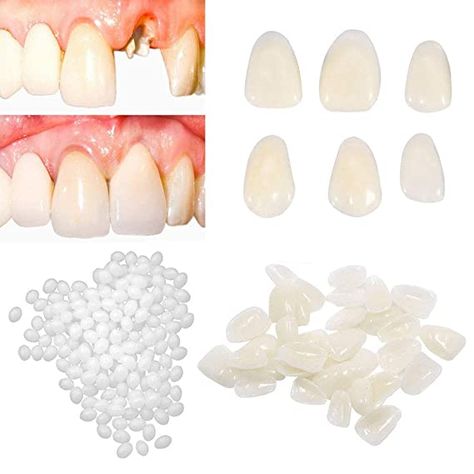 Denture Repairs, Tooth Crown, Fix A Zipper, Tooth Filling, Temporary Tooth, Tooth Repair, Dental Restoration, Veneers Teeth, False Teeth