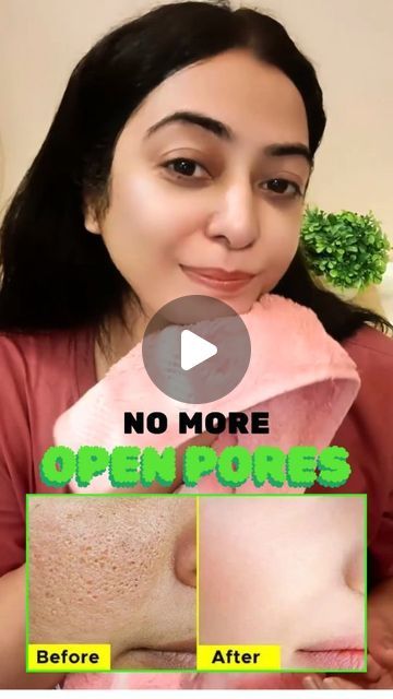 Pooja Luthra | If you want to get rid of open pores large pores, then this remedy is magical for you, it will tighten your pores and will make your skin... | Instagram How To Get Rid Of Pores On Face Natural, How To Remove Pores On Face Naturally, Face Open Pores Remedy, Skin Care For Open Pores, Skin Pores Remedies, How To Remove Pores On Face, Face Skin Care Routine Natural, Open Pores Remedy Natural Treatments, Open Pores On Face How To Get Rid