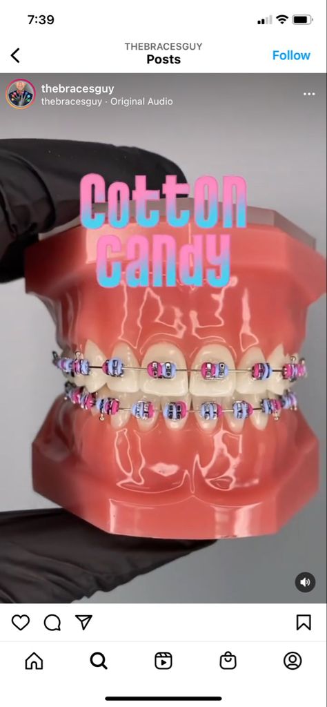 Cotton Candy Braces, Braces Patterns, Cute Braces Colors, Braces Tips, Cute Braces, Brace Face, Clay Bead Necklace, Braces Colors, Dental Braces