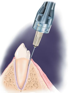 As local anesthesia only lasts for a short time, it is primarily used for minor outpatient procedures, where the patient can leave on the same day of the surgery. Dental Anesthesia, Local Anesthesia, Kids Dentist, General Anaesthesia, Dental Procedures, Cosmetic Dentistry, Surgery, Jay, The Globe