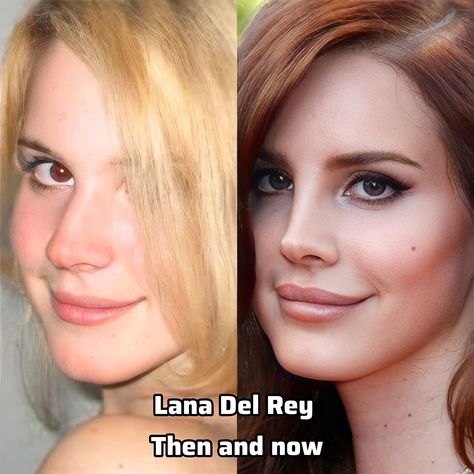 Before and after nose job and lip filler. I would like to remind you that the rhinofiller does not change the height or width of the nose but corrects small defects, so it is obviously redone. Lana Del Rey Nose Job, Lana Del Rey Lip Filler, Lip Filler On Small Lips, Lip Fillers Before And After, Nose Job Before And After, Lip Filler Before And After, Lana Del Rey Lips, Before And After Nose Job, Nose Filler