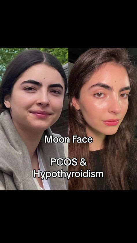 Mila Magnani, Moon Face Swelling, Face Swelling, Puffy Face, High Cortisol, Face Tips, My Mental Health, Face Face, Thyroid Function