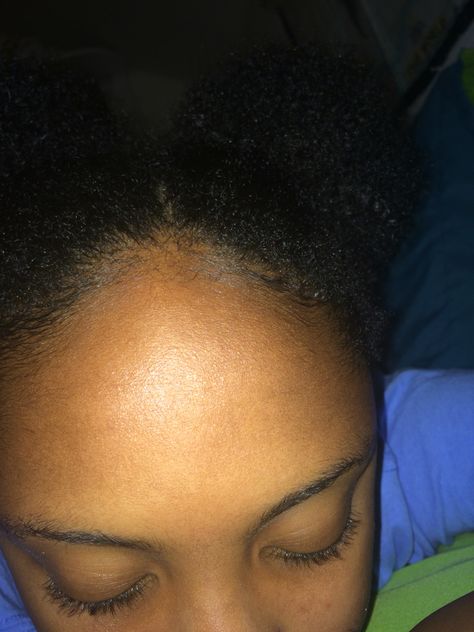 Big forehead, edges and some Afro puffs Afro Puffs, Big Forehead, Afro Puff, Hair