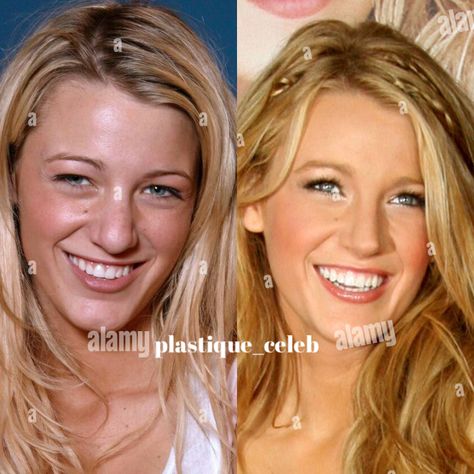 #blakelively #serenavanderwoodsen #blairwaldorfstyle #celebritynews #gossipgirl #plasticsurgery #beautyblog #celebritygossip #rhinoplasty #fillers #botoxtips #blepharoplasty Blake Lively Nose, Blair Waldorf Style, Serena Van Der Woodsen, Beauty Standards, Cosmetic Surgery, Blake Lively, Celebrity Gossip, Plastic Surgery, Gossip Girl