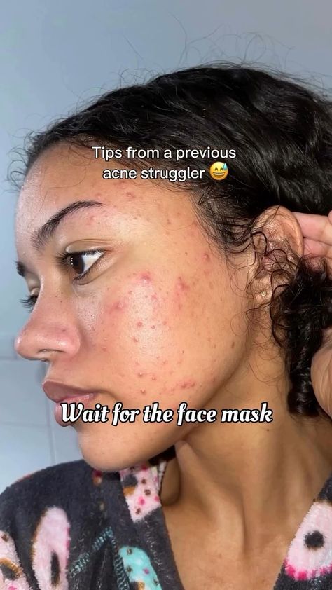 Home Remedy For Face Acne, How To Get Rid Of Blemishes, Skincare Routine For Hormonal Acne, How To Get Rid Of Stubborn Acne, Skincare Routine For Acne And Scars, How To Clear Face Acne, Healthy Skin Tips For Acne, Face Mask For Acne And Pimples, Simple Skincare Routine For Acne