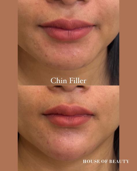 Chin filler House of Beauty Camberley Chin And Jawline Fillers, Facial Balancing Filler, Facial Harmony, Chin Filler, Cleft Chin, Facial Structure, Hyaluronic Acid Fillers, Botox Fillers, House Of Beauty