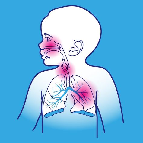 Is croup contagious? Understand how croup spreads, its symptoms, and potential risks. Get clear insights on croup's contagious nature. - #Cancroupspread? #closecontacttransmission #contagiouscroupsymptoms #contagiousphaserecognition #croupinfection #croupspreading #crouptransmission #Croup:Howcontagious?. #Doescrouptransmit? #earlytransmissiondetection #Iscroupcommunicable? #Iscroupinfectious? #respiratorydropletsspread #viralcontagionrisks Baby Nasal Congestion, Upper Respiratory Tract, Data Patterns, Bad Cough, Upper Respiratory Infection, Target Kids, Respiratory Infection, Cat Spray, Cold Cough