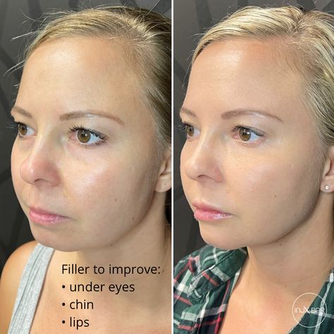 Chin Filler, Under Eye Fillers, Cheek Fillers, Polycystic Ovaries, Under Eyes, School Communication, Creating A Newsletter, Healthy Routine, Lip Fillers