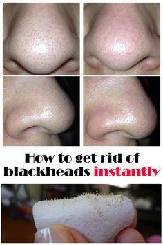 Clogged Pores On Nose, Clean Nose Pores, Get Rid Of Clogged Pores, Get Rid Of Pores, Nose Pores, Black Heads, Rid Of Blackheads, Remove Blackheads, Baking Soda Shampoo