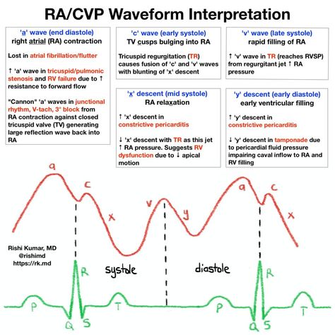 RA/CVP Waveform Interpretation Cath Lab Nursing, Cardiac Cath Lab, Central Venous Pressure, Anesthesia School, Cardiac Cath, Cardiac Sonography, Cardiology Nursing, Ekg Interpretation, Ecg Interpretation