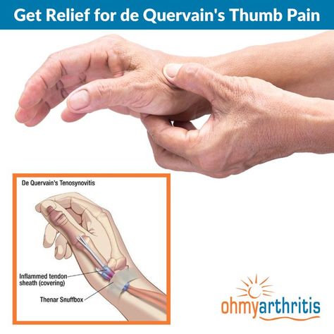 De Quervain's Tenosynovitis, or Mommy's Thumb, is a painful condition caused by inflammation and swelling in the tendons on the thumb side of the wrist and up the side of the forearm. Learn more about this condition and how it can be treated here Thumb Pain Relief, Hand Therapy Exercises, Wrist Pain Relief, Inflammation Remedies, Thumb Splint, K Tape, Joints Pain Remedy, Hand Health, Arthritic Pain