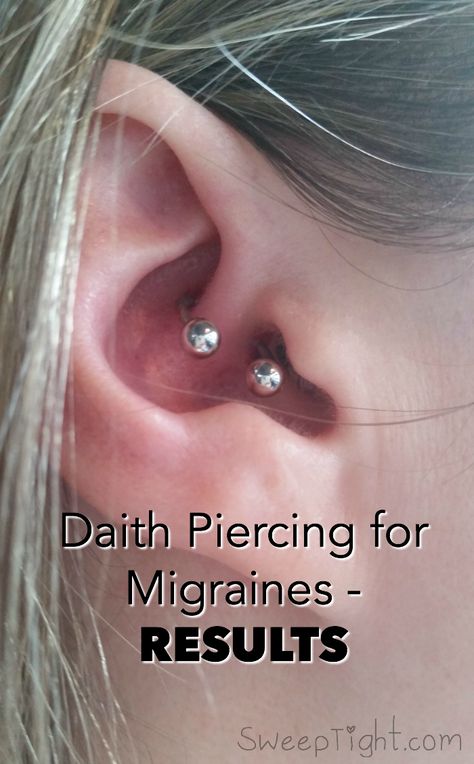 Piercing For Migraines, Ear Piercing For Migraines, Daith Piercing Migraine, Migraine Piercing, Migraine Help, Daith Piercings, Severe Migraine, Headache Prevention, Natural Headache Remedies