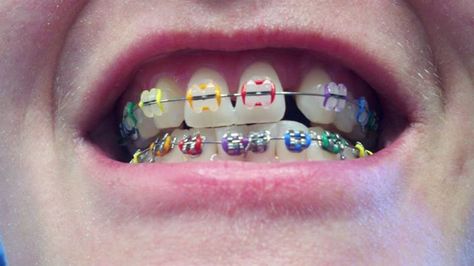 Ceramic and metal braces with bands! Colored Braces, Ortho Marketing, Braces Ideas, Ceramic Braces, Adult Braces, Clear Braces, Brace Face, Braces Colors, Orthodontics Braces