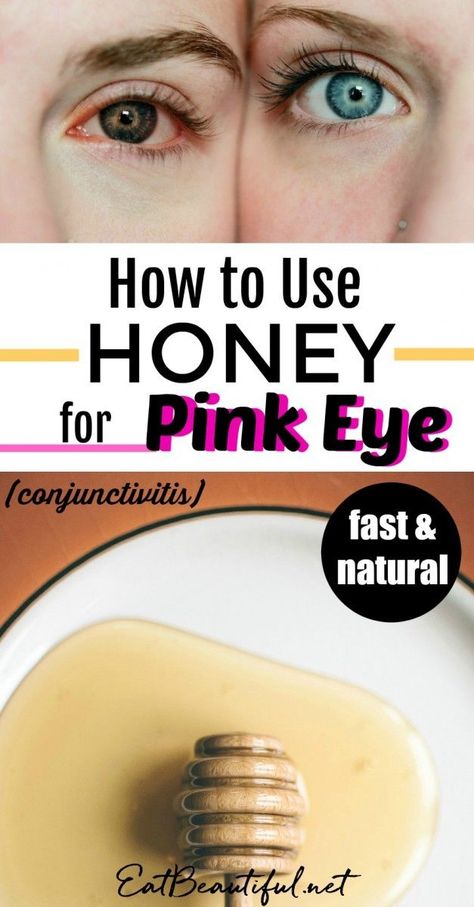 Honey is the fastest and most effective remedy I've used for pinkeye. This post shares with you how to use it, why it works and some other natural approaches. | Eat Beautiful || #pinkeye #honey #DIY #remedy Treating Pink Eye, Pink Eye Home Remedies, Natural Pink Eye Remedy, Honey Health Benefits, Pinkeye Remedies, Eat Beautiful, Holistic Health Remedies, Pink Eye, Natural Cold Remedies