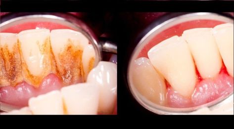 Tartar Teeth, Tartar Removal, Dental Health Care, Tomato Nutrition, Teeth Health, Periodontal Disease, Hygiene Products, Oral Health Care, Cosmetic Dentistry