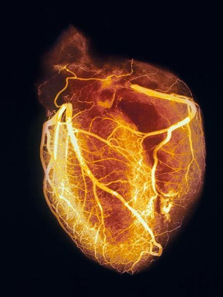 Angiogram of heart- the brightly colored   lines are blood vessels, dyed for the procedure. This is an unusual pic, you   normally just see the lines and a very faint outline of the chambers, but I do   love this! Cardiovascular Anatomy, Coronary Arteries, Heart Pictures, Human Heart, Cardiology, Foto Art, Medical Science, Anatomy And Physiology, Blood Vessels