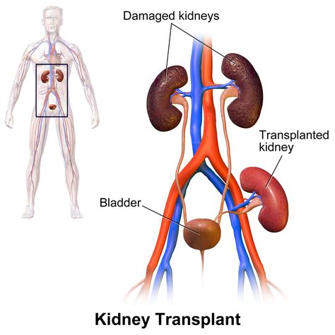 Literature Polycystic Kidneys, Kidney Pain, Kidney Donor, Organ Transplant, Kidney Health, Biology, Human Body, Human