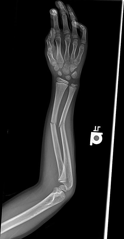 X-rays of Broken Bones | The above x-rays are before the bones were set and the ones below were ... Arm Bones, Broken Ribs, Bone Fracture, Broken Arm, X Rays, Bone Art, Orthopedic Surgery, Banana Milk, Broken Leg