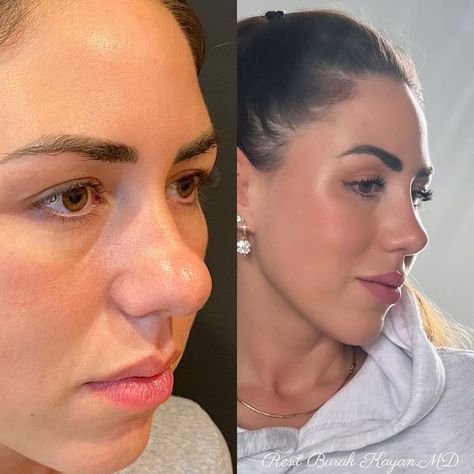 Nose Job Thick Skin, Thick Skin Rhinoplasty, Bulbous Nose Rhinoplasty Before After, Jaw Reduction Surgery, Ethnic Rhinoplasty, V Line Surgery, Bulbous Nose, Plastic Surgery Fail, Korean Plastic Surgery