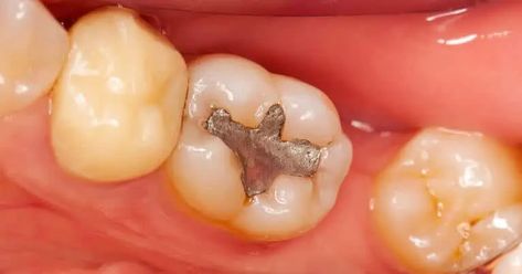 Amalgam vs. Composite Fillings: Which is Best for You? - Dentaly.org Composite Fillings, Amalgam Fillings, Cavity Filling, Dental Advertising, Tooth Filling, Dental Fillings, World Health Organization, First Tooth, Healthy Teeth