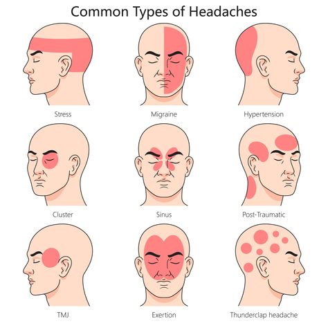 Nature Home Health Headache Chart, Migraine Pain, Medical Wallpaper, Nature Home, Migraine Relief, Headache Relief, Migraine Headaches, Massage Techniques, Home Health