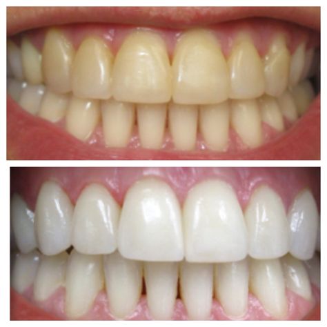 Before and after Teeth Before And After, Teeth Whitening Before And After, Laser Teeth Whitening, Teeth Bleaching, Sale Logo, Teeth Health, Dental Art, Dental Teeth, Beauty Recipe