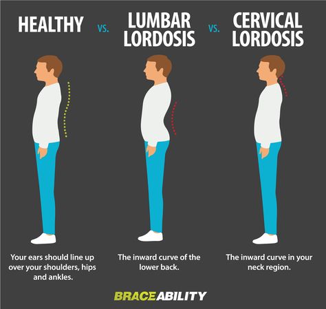 What is lordosis? This condition is commonly known as “swayback” and can either occur in your cervical or lumbar back region, sometimes both. If you have this condition, it may appear that you are sticking out your buttock or sticking your head forward. L Intercostal Muscles, Lumbar Lordosis, Posture Improvement, Pregnancy Pain, Forward Head Posture, Posture Exercises, Mohammed Ali, Spine Health, Upper Back Pain