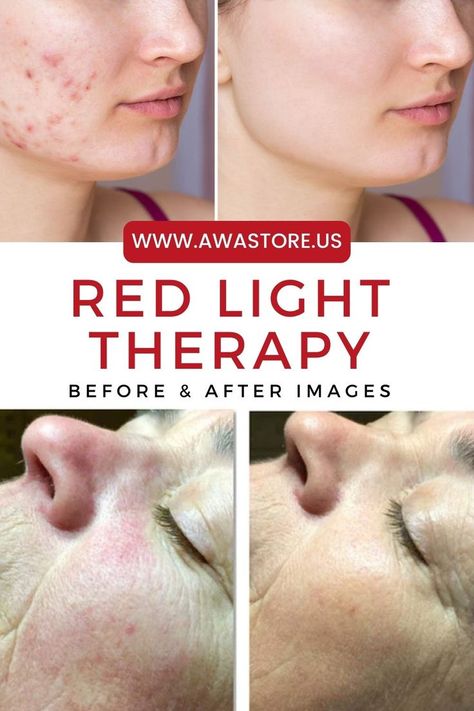 Witness the incredible results of red light therapy through before and after images. These photos showcase remarkable transformations in skin quality, wrinkles, and more. Get inspired to unlock your radiant self! #BeforeAndAfter #RedLightTherapy #SkinTransformation Red Light Therapy Results, Red Light Therapy Benefits, Lack Of Energy, Diy Skincare, Acne Remedies, Body Detox, Red Light Therapy, After Photos, Light Therapy