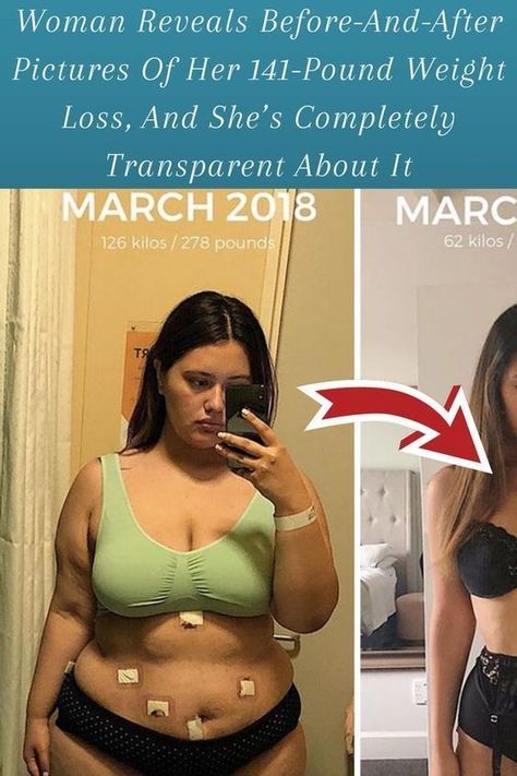 50lbs Before And After, Zepbound Before And After, Vsg Before And After, Ozempic Before And After, Environment Facts, Sleeve Surgery, Health And Wellness Quotes, A Burden, Pet Wellness