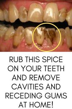 Reverse Cavities, Tooth Cavity, Tooth Decay Remedies, Remedies For Tooth Ache, Teeth Health, Tooth Sensitivity, The Teeth, Receding Gums, Gum Care