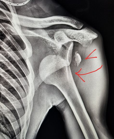 #Shoulder xray: anterior #dislocation of humeral head (arrow) with an #avulsion #fracture of the greater tuberosity (arrowhead). #radiologist #radiology #pain #trauma #injury Shoulder Xray, Avulsion Fracture, Radiology, X Ray, Quick Saves