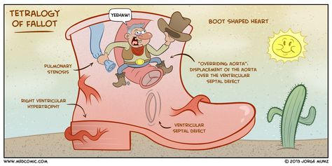 Tetralogy of Fallot | Medcomic Tetralogy Of Fallot, Peds Nursing, Nursing Board, Nursing Mnemonics, Congenital Heart Defect, Cardiac Nursing, Pa School, Nursing School Survival, Congenital Heart