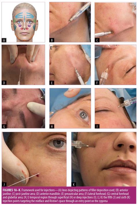 The 12-point Revitalization Guide to Pan-facial Application of Injectable Fillers in Older Women – JCAD | The Journal of Clinical and Aesthetic Dermatology Face Injections, Botox Injection Sites, Facial Injections, Cosmetic Fillers, Facial Aging, Face Fillers, Aesthetic Dermatology, Facial Anatomy, Botox Face