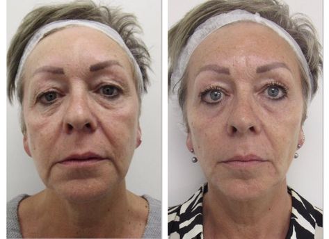 Thread Lift: Complications, Before and After, Recovery, and Cost Thread Lift Face, Mini Face Lift, Face Threading, Laser Peel, Eyebrow Lift, Face Lift Surgery, Cheek Fillers, Makeup Tips For Older Women, Thread Lift