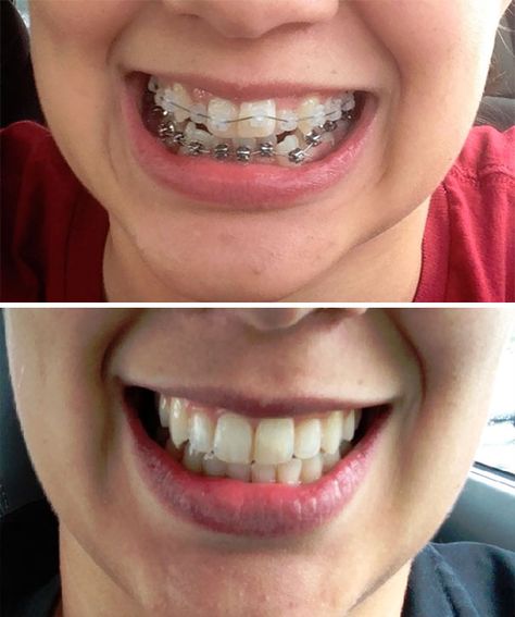 Braces Journey, Braces Before And After, Surgery Room, Teeth Whitening Methods, Tooth Pulled, Braces Tips, Hollywood Smile, Braces Off, Higher Art