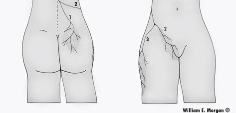 thoracolumbar junction syndrome or magine's syndrome Neuroplasticity Exercises, Hip Anatomy, Hip Flexor Pain, Myofascial Pain Syndrome, Bursitis Hip, Piriformis Stretch, Hip Pain Relief, Hip Problems, Piriformis Syndrome