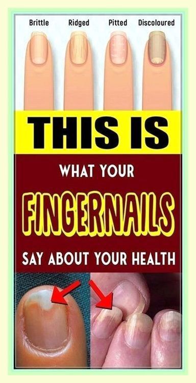 You are so kind. Distinguished  info! Nail Health Signs, Fingernail Health, Nail Disorders, Nail Conditions, Health Signs, Nail Health, Health Tips, Disease, Health