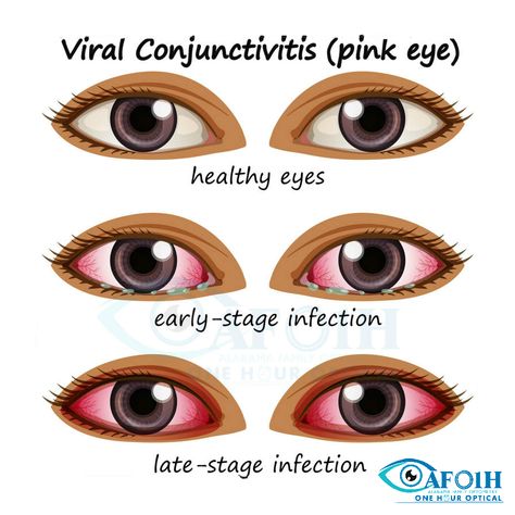 Conjunctivitis is a common eye problem and can be easily treated with a few simple precautions. Learn more about it at: http://afoptometry.com/Conjunctivitis.aspx  #Alabama #AFO #Optometry #AlabamaFamilyOptometry #Conjunctivitis Conjuctivita Eye, Eye Care Tips, Anniston Alabama, February Nails, Healthy Eyes, Eye Exam, Eyes Problems, Eye Doctor, Pink Eyes