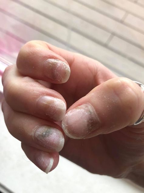 Green Nail Syndrome, Nail Remedies, Nail Discoloration, Nails After Acrylics, Fingernail Fungus, Nail Problems, Nail Infection, Nail Fungus Remedy, Powder Manicure