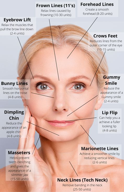 Botox Injection Sites, Facial Injections, Eyebrow Lift, Aesthetic Dermatology, Facial Anatomy, Botulinum Toxin, Botox Face, Facial Fillers, Cosmetic Injectables