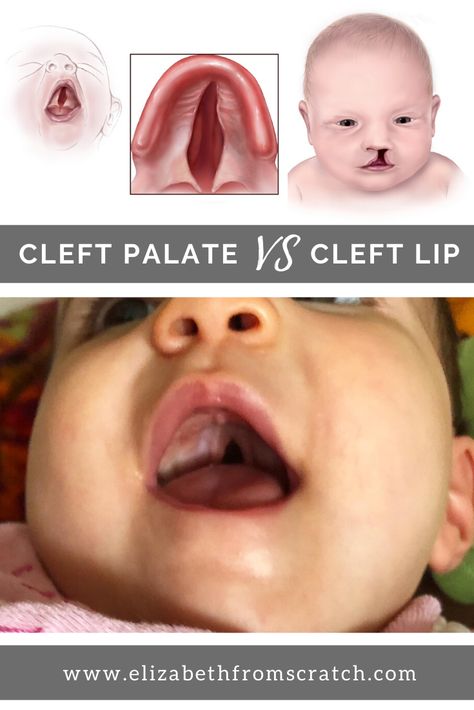 July is Cleft and Craniofacial Awareness Month! Did you know that about 1 out of every 700 babies is born with a facial cleft?  Many people assume cleft palate and cleft lip are the same thing. However, they are very different! Check out this post to learn more about these two birth defects. Oral Pathology, Cleft Lip And Palate, Cleft Palate, Cleft Lip, List Of Questions, Body Tissues, Upper Lip, The Roof, Go Outside